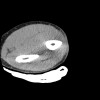 SPORK, NICO - 22.03.1976 - 02.08.2022 - CT obere Extremität - 17:56:57